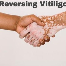 Vitiligo